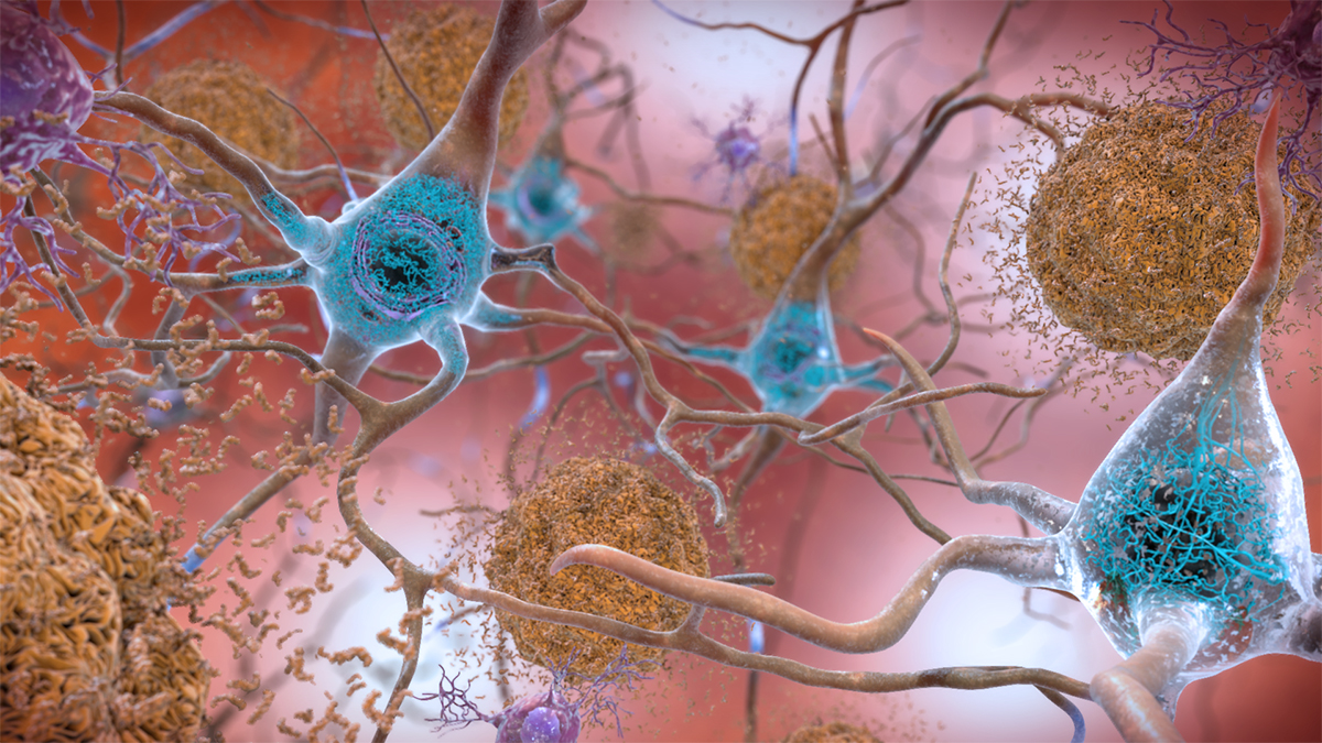 Illustration of amyloid plaques and tau tangles, colored in brown, surrounded by brain cells, colored in cyan and purple.