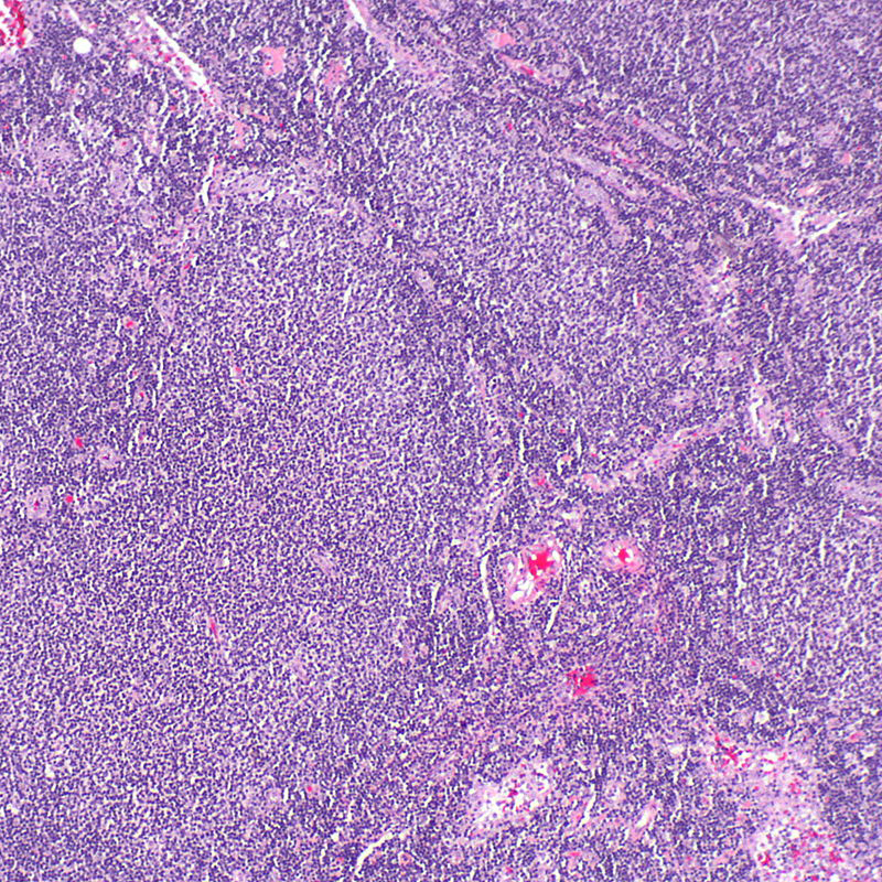 Follicular lymphoma