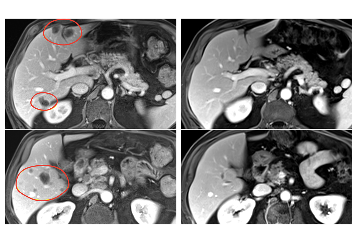 Cancer Immunotherapy Image of an MRI scan showing shrinkage of multiple liver metastases from a patient with rectal cancer.