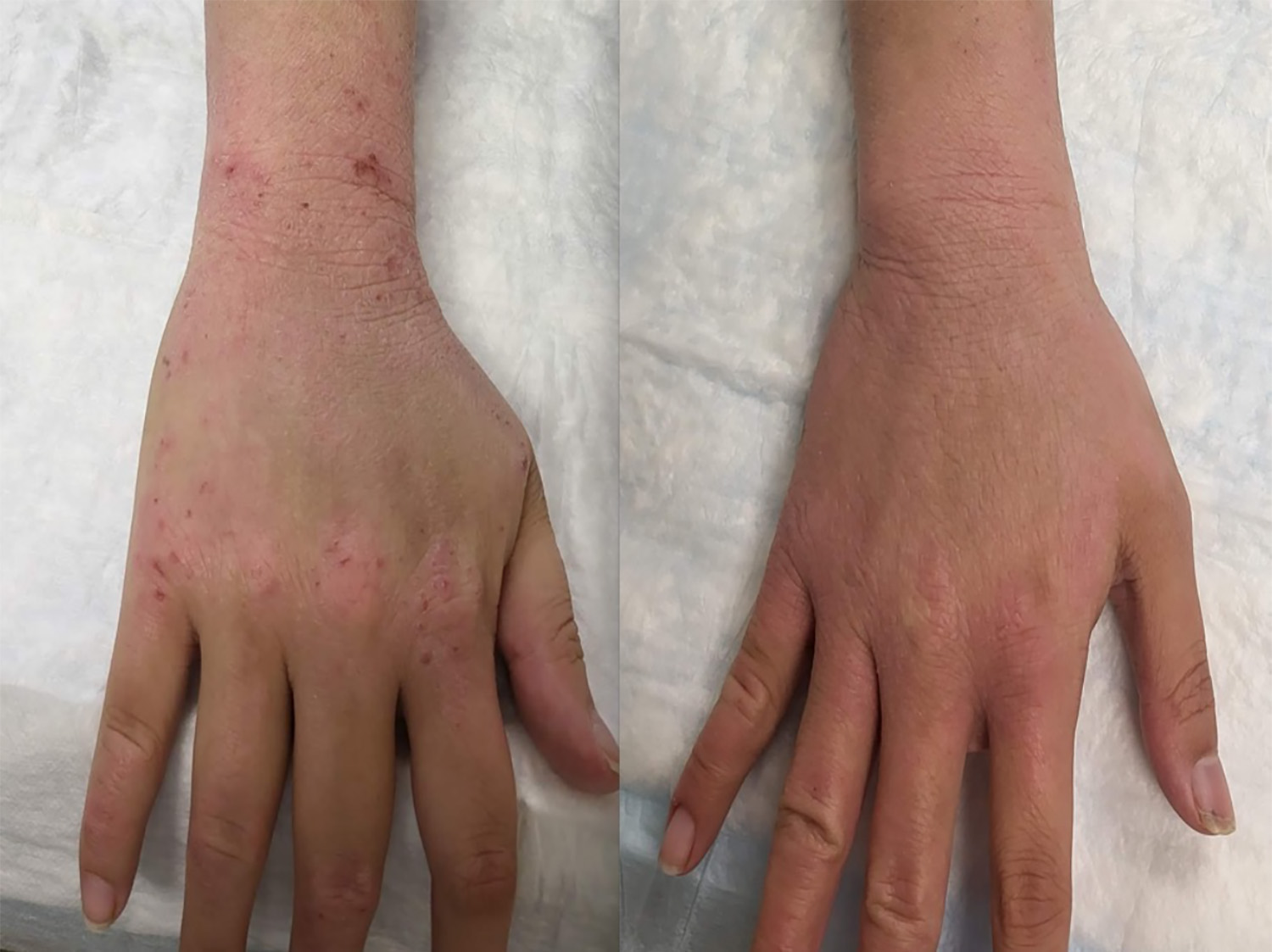 TSW Treatment Two photos of the same hand. On the left, the skin has a red rash. On the right, the skin does not.