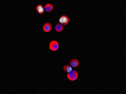 Tumor cells color red and blue.