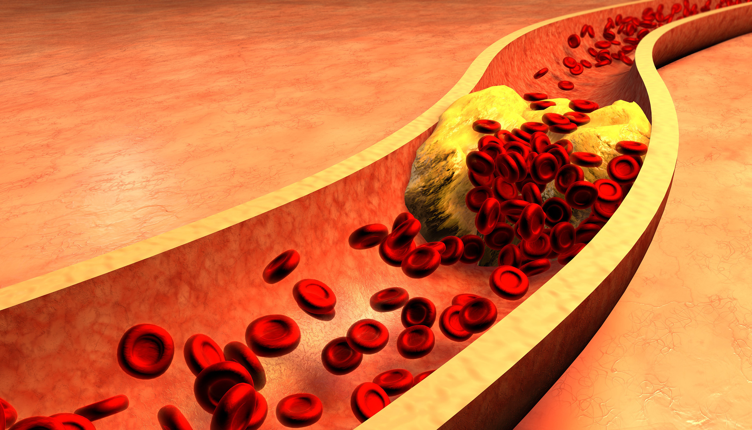 Illustration of artery narrowed by plaque.