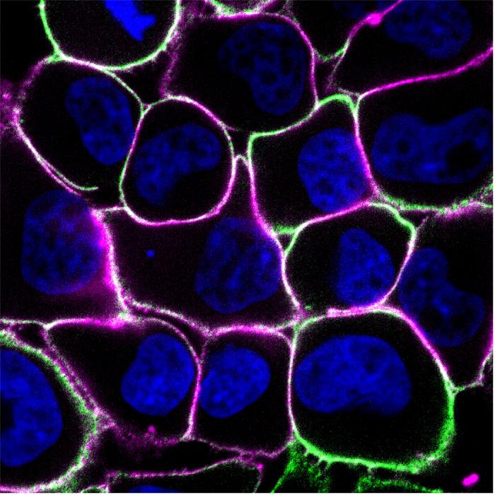 Human breast cancer cells. Human breast cancer cells.