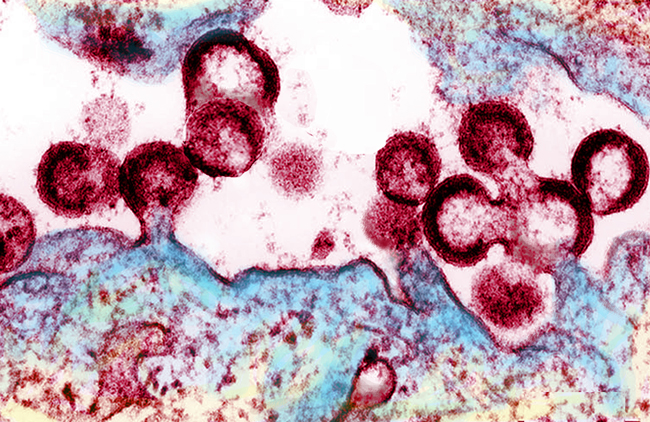 HIV virions budding and releasing from an infected cell.