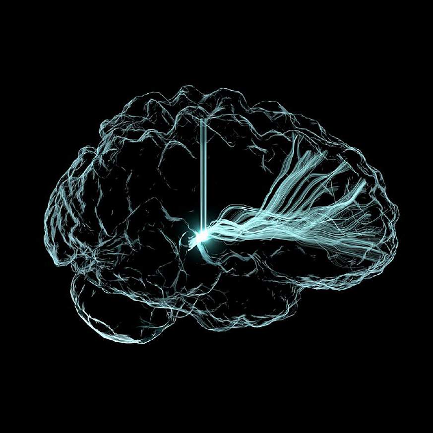 Deep Brain Stimulation Illustration Deep Brain Stimulation Illustration