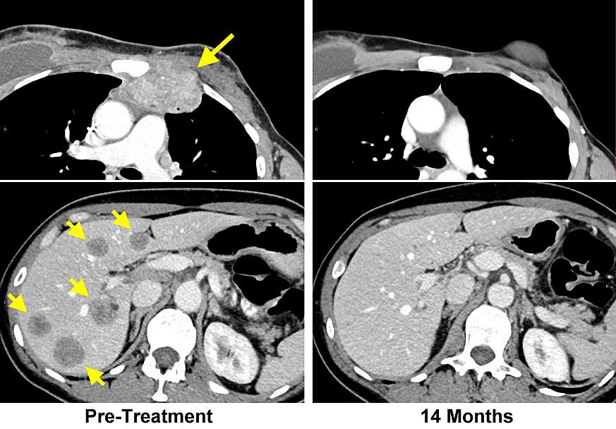 CT scans from cancer patient CT scans from cancer patient