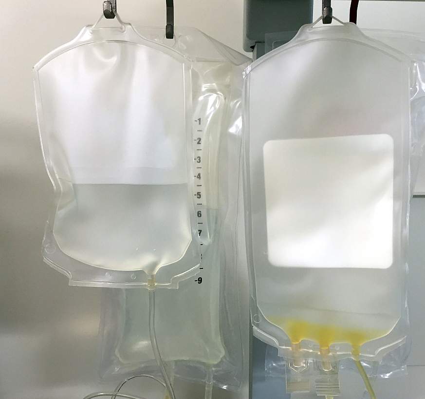 Bags of fluid for intravenous (IV) infusions. Image of bags of fluid for IV infusions
