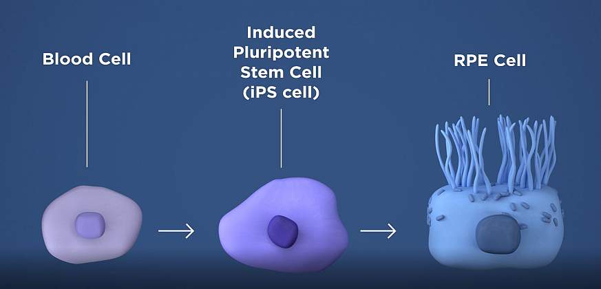 Illustration of a blood cell turning into an induced pluripotent stem cell and then an RPE cell. Illustration of a blood cell turning into an induced pluripotent stem cell and then an RPE cell.