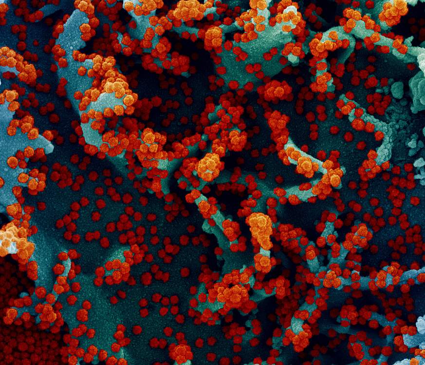 Colorized scanning electron micrograph of a human cell heavily infected with SARS-CoV-2 virus particles (red). Colorized scanning electron micrograph of a human cell heavily infected with SARS-CoV-2 virus particles (red).