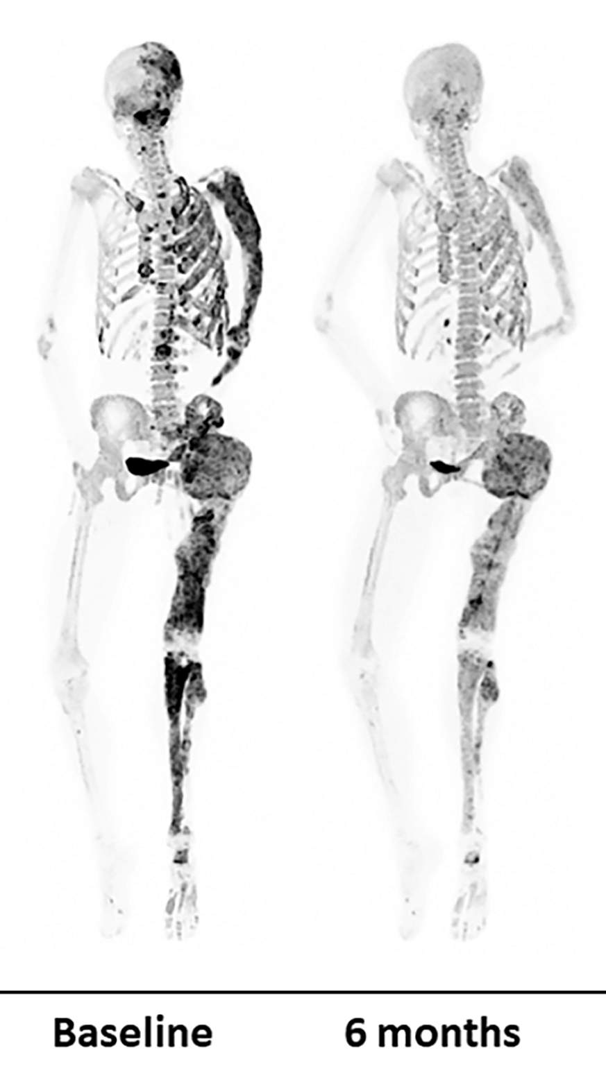Before and after bone scans Before and after bone scans