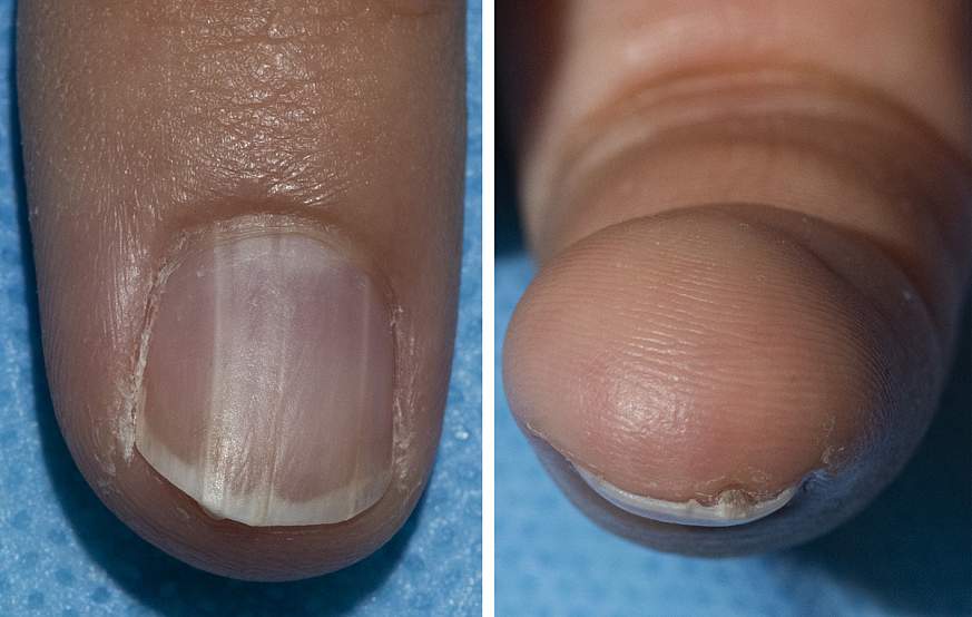 Image of a fingernail with onychopapilloma