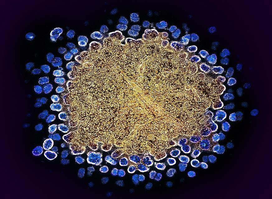 HIV-1 Virus Particles Replicating HIV-1 Virus Particles Replicating