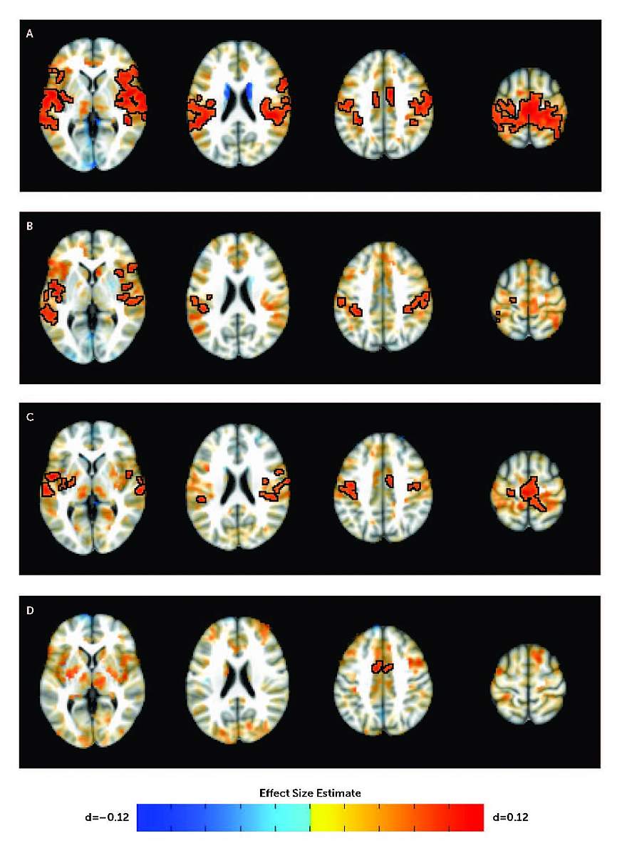 Image showing differences in subcortico-cortical connectivity in youth with and without ADHD. Image showing differences in subcortico-cortical connectivity in youth with and without ADHD.