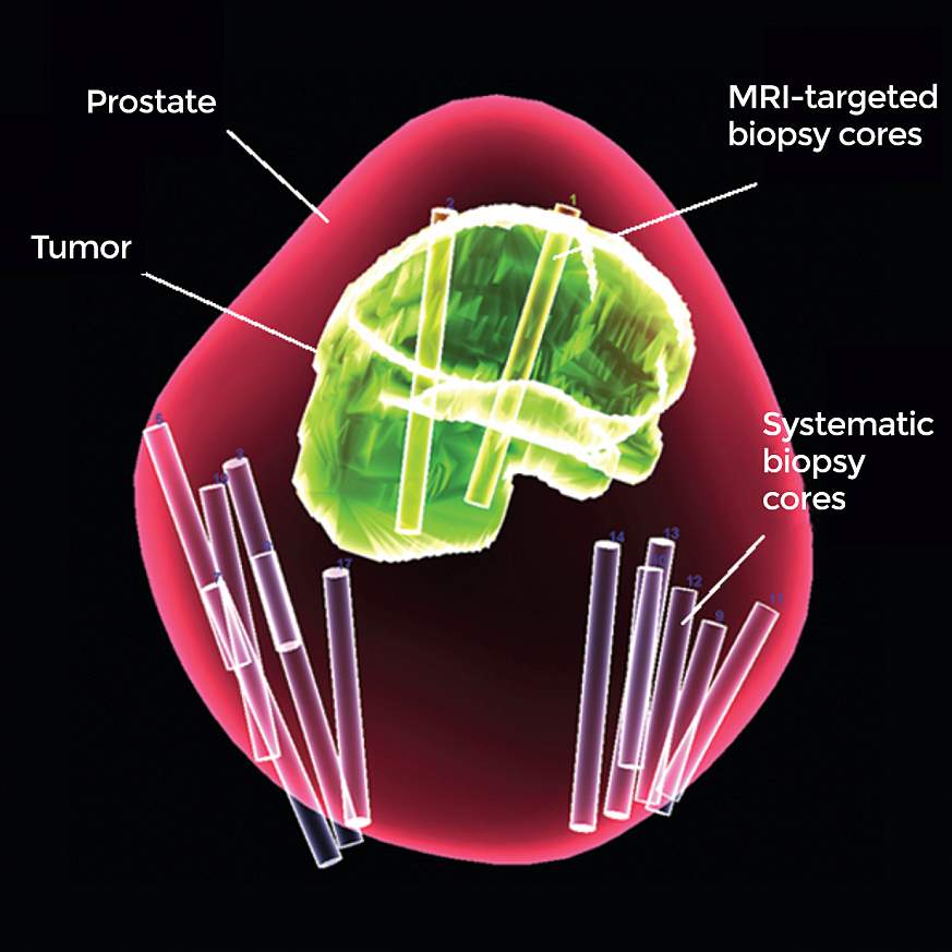 3D illustration of the prostate MRI-targeted biopsy cores in a tumor and 12 systematic biopsy cores elsewhere in a prostate