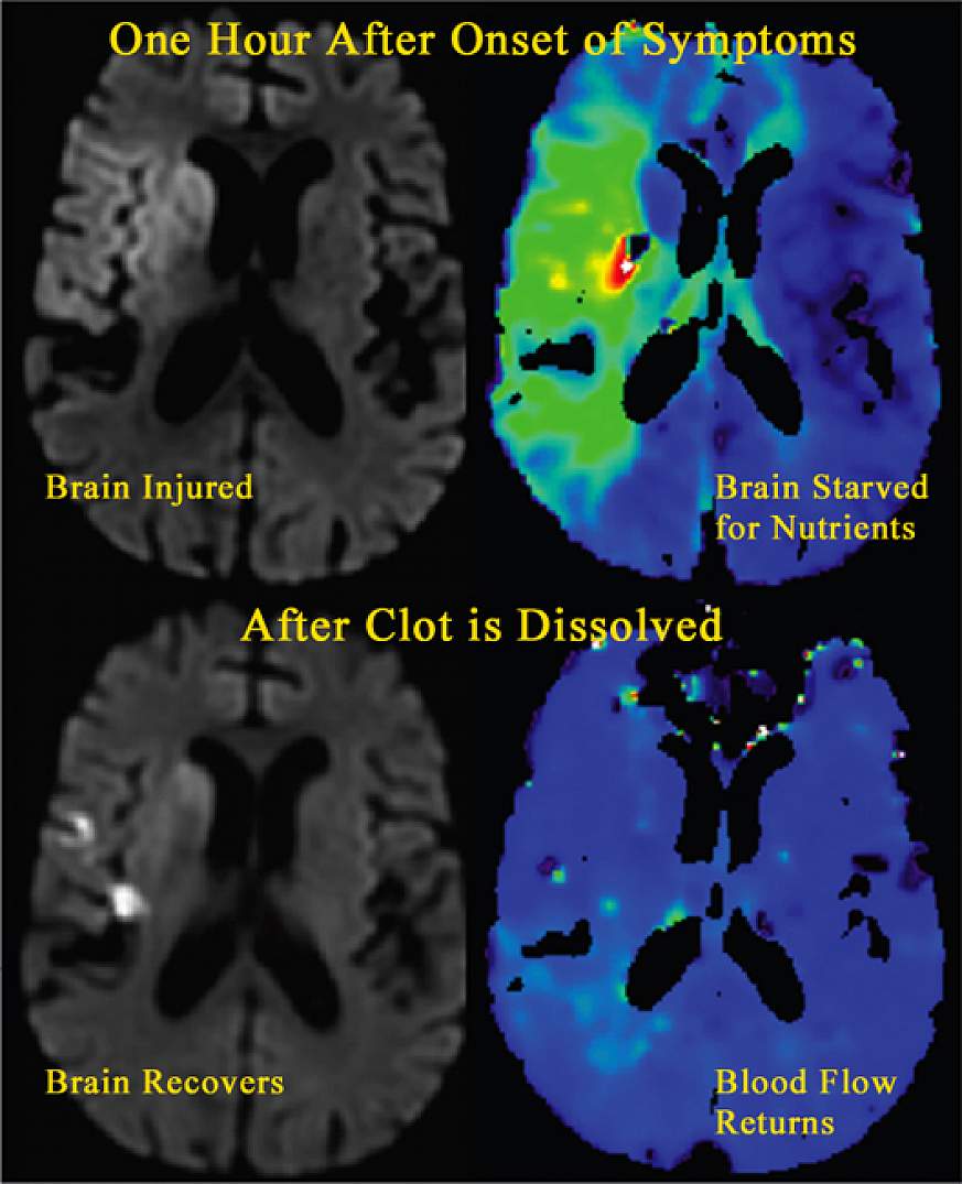 MRI images showing an ischemic stroke as it is happening and as it recovers MRI images showing an ischemic stroke as it is happening and as it recovers.