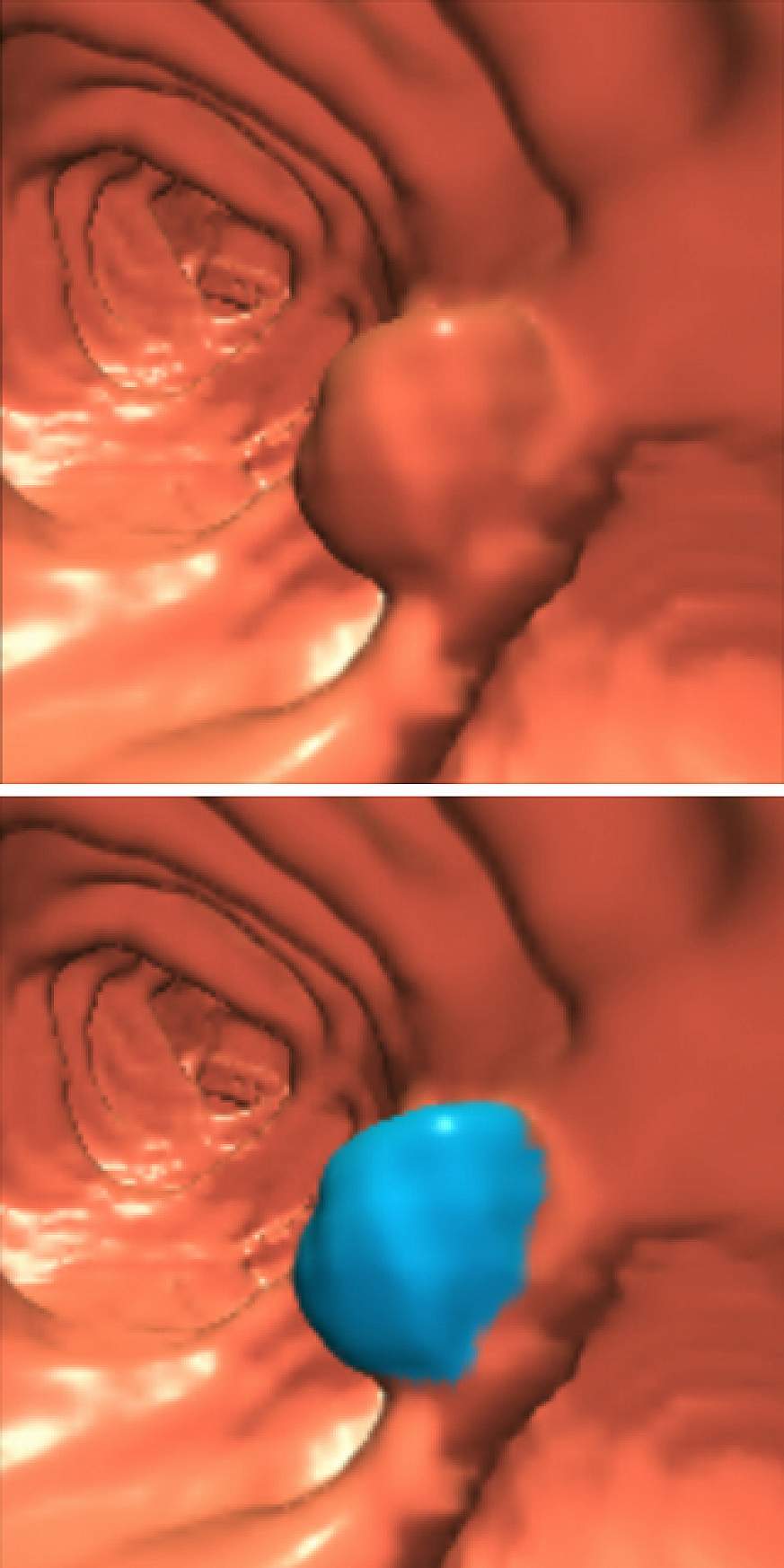 Computer generated image of a colon polyp Computer generated image of a colon polyp.