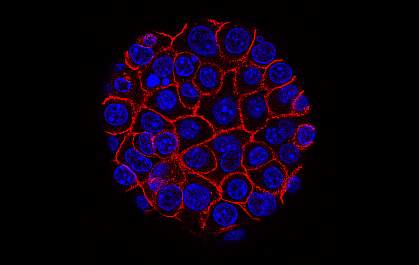 Pancreatic Cancer Cells Pancreatic Cancer Cells