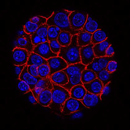 Pancreatic cancer cells Pancreatic cancer cells