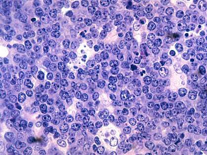 Burkitt’s lymphoma under the microscope Burkitt’s lymphoma under the microscope
