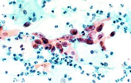 a microscopic image of cervical cancer a microscopic image of cervical cancer