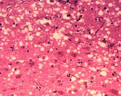 photo of prions photo of prions