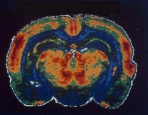 Brain scans showing healthy brain on top nicotine brains on the bottom Brain scans showing healthy brain on top nicotine brains on the bottom