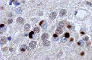 Picture of misfolded disease proteins (deep red) in the brain of someone with frontotemporal dementia Picture of misfolded disease proteins (deep red) in the brain of someone with frontotemporal dementia