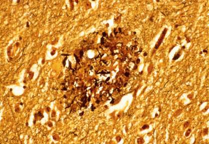 Darker orange/brown material in a section of human brain tissue Darker orange/brown material in a section of human brain tissue