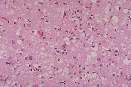 Section of pink brain tissue is riddled with white holes Section of pink brain tissue is riddled with white holes