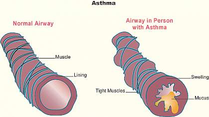 Illustration shows a normal lung tubule and an asthmatic tubule, with a central airway narrowed by tight muscles, swelling and mucus Illustration shows a normal lung tubule and an asthmatic tubule, with a central airway narrowed by tight muscles, swelling and mucus