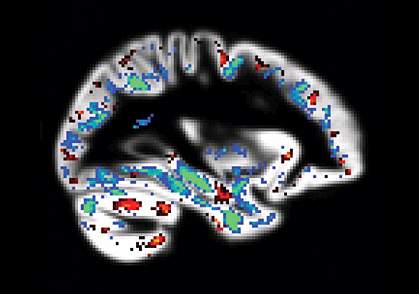 Image of brain with scattered, small areas of color Image of brain with scattered, small areas of color