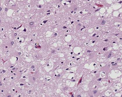 Pink stained brain tissue riddled with white holes Pink stained brain tissue riddled with white holes