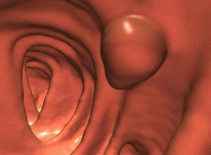 Image produced using virtual colonoscopy technology Image produced using virtual colonoscopy technology