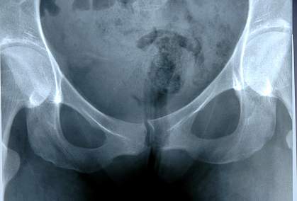 Photo of xray image of a human female's pelvis Photo of xray image of a human female's pelvis