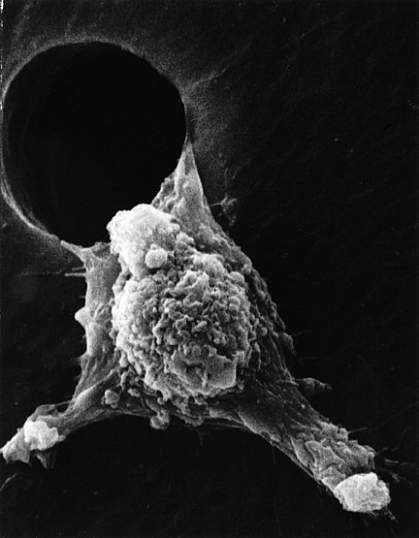 Scanning electron micrograph of cancer cell Scanning electron micrograph of cancer cell