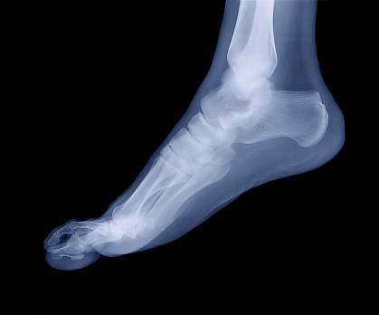 X-ray image of a human foot X-ray image of a human foot