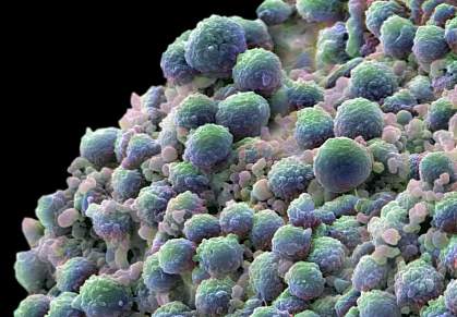 Several lumpy round cells Several lumpy round cells