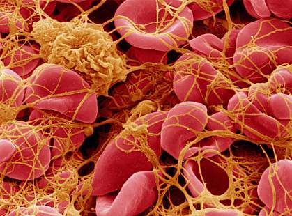 Image of clotted blood cells Image of clotted blood cells