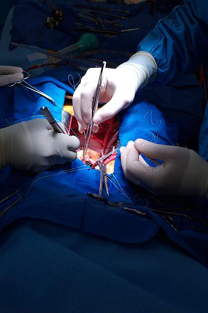 Photo of heart surgery Photo of heart surgery