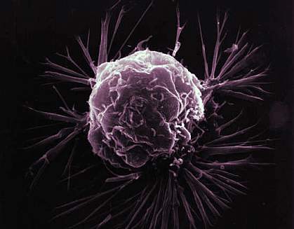 Close-up photo of a breast cancer cell Close-up photo of a breast cancer cell