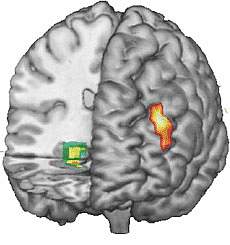 Image of Functional MRI data superimposed on 3-D MRI reconstruction of the brain Image of Functional MRI data superimposed on 3-D MRI reconstruction of the brain