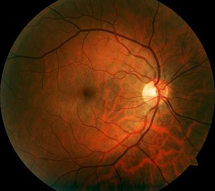Photo of human retina Photo of human retina