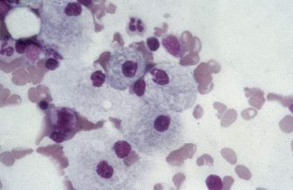 Photo of engorged cells Photo of engorged cells