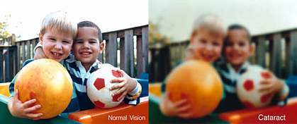 A very blurry photo of two boys, illustrating vision with a cataract A very blurry photo of two boys, illustrating vision with a cataract