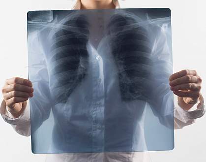 Photo of a lung x-ray held in front of a woman's chest Photo of a lung x-ray held in front of a woman's chest