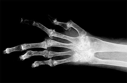 x-ray image of a human hand with several bent fingers x-ray image of a human hand with several bent fingers