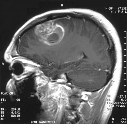Brain MRI showing bright mass Brain MRI showing bright mass