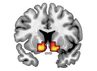 Brain image with 2 small red and yellow patches Brain image with 2 small red and yellow patches.