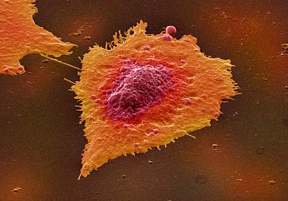 Image of a human colon cancer cell Image of a human colon cancer cell