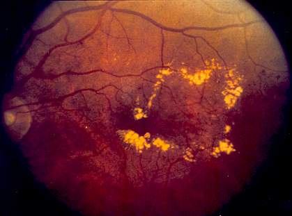 Photo of eye with yellow spots near dark macula at the center Photo of eye with yellow spots near dark macula at the center